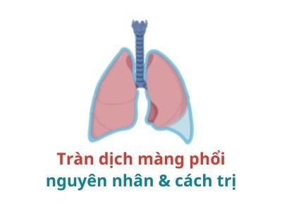 Thông tin cần biết về tràn dịch màng phổi và cách điều trị